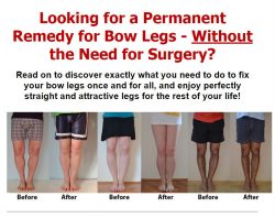 Permanent Remedy for Bow Legs