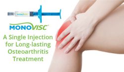 Monovisc – A Single Injection for Long-lasting Osteoarthritis Treatment