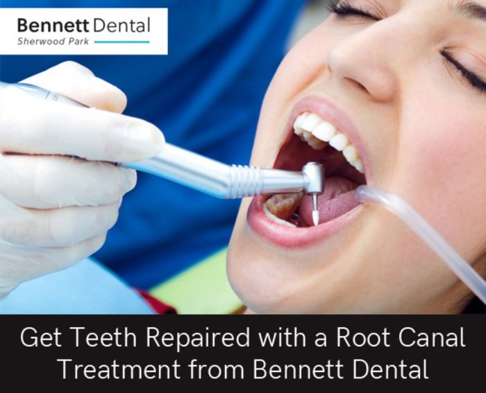 Get Teeth Repaired with a Root Canal Treatment from Bennett Dental