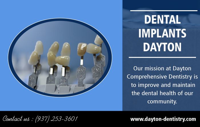 Dental Implants Dayton