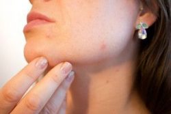 Limpieza anti acné