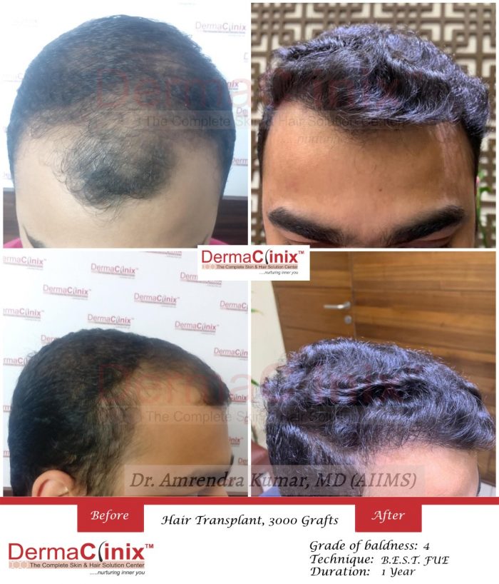 Another dramatic transformation by our flagship patented procedure B.E.S.T. (Bio-Enhanced Simult ...