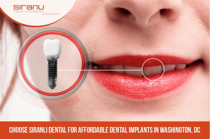 Choose Siranli Dental for Affordable Dental Implants in Washington, DC