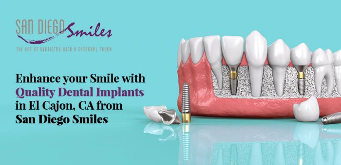 Enhance your Smile with Quality Dental Implants in El Cajon, CA from San Diego Smiles