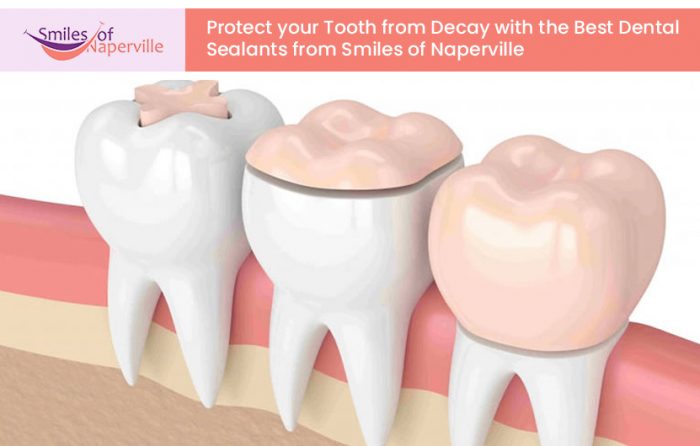 Protect your Teeth from Decay with the Best Dental Sealants from Smiles of Naperville