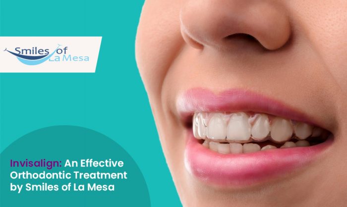 Invisalign: An Effective Orthodontic Treatment by Smiles of La Mesa