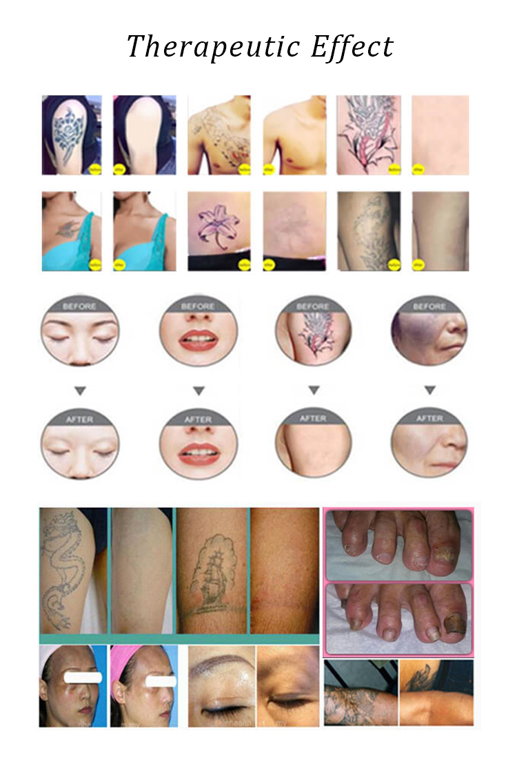 q switched nd yag laser tattoo removal machine manufacturer