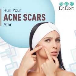 Acne Scar Reduction in Bangalore