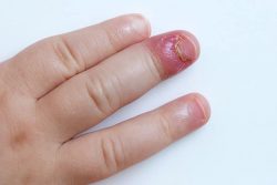 How To Treat An Ingrown Fingernail