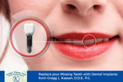 Replace your Missing Teeth with Dental Implants from Gregg L. Kassan, D.D.S., P.C.