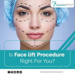 Face Lift Surgery