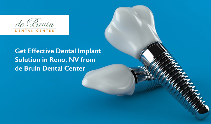 Get Effective Dental Implant Solution in Reno, NV from de Bruin Dental Center