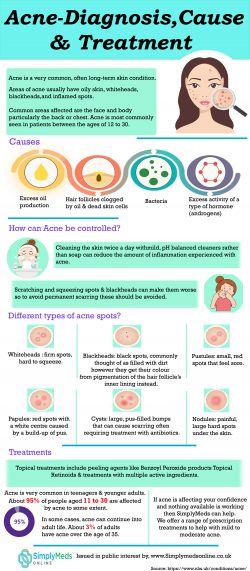 Acne – Diagnosis, Cause & Treatment