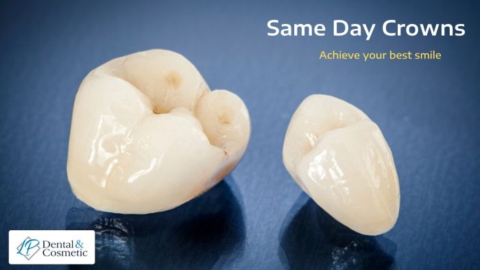 Ceramic Dental Crowns for Your Teeth