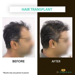 Best Hair Transplant Doctor in Hyderabad