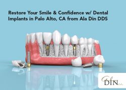 Restore Your Smile & Confidence w/ Dental Implants in Palo Alto, CA from Ala Din DDS