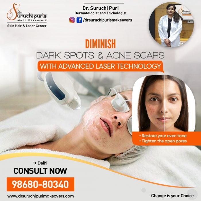 Reduce Dark Spots and Acne Scars with the Best Skin Specialist in Delhi
