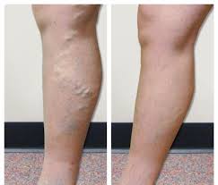 How To Remove Spider Veins ?