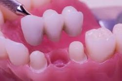 What is the Dental Bridge Procedure?