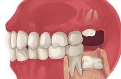 Wisdom Tooth Extraction Near Me