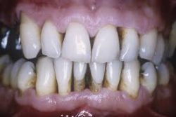 Periodontal Disease: Causes and Prevention