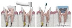 Do You Need Root Canal Treatment ?