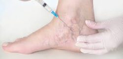 Sclerotherapy Treatment Near Me