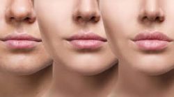 Best Place For Fillers In Boston