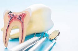 Emergency Root Canal Treatment