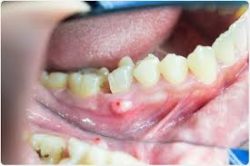 What are the Common Symptoms of a Dental Abscess?