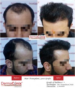 Hair Transplant Result in Delhi