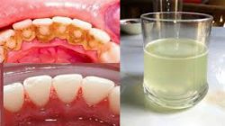 Tartar and Plaque Extraction Houston TX