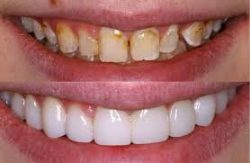 COSMETIC DENTISTRY TREATMENTS