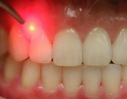Laser Gum Treatment Dentist Houston