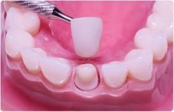 One of The Best Dental Crowns Treatment Houston