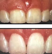 Laser Gingivectomy Treatment Near Me