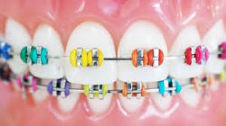 The Process Behind Choosing Braces Band Colors?
