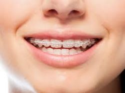 Teeth Straightening and Types of Orthodontic Appliances