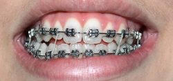 HOW DO TOOTH BRACES WORK?