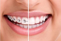 What is the Best Option of Braces for Adults?