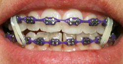 BEST ORTHODONTIST FOR BRACES NEAR ME ON A BUDGET