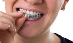 The Benefits of Choosing Invisalign Braces | Invisalign Consultation Today