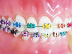 Teeth Cleaning and Wearing Braces – Get Your Orthodontist Help