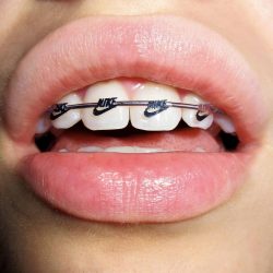 GET A NEW SMILE WITH THE BEST INVISIBLE BRACES