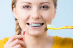 Getting Braces And What You Should Know