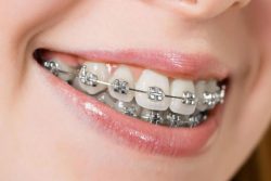 Best Orthodontist Near Me Which Invisalign Miami And Invisible Braces To Choose