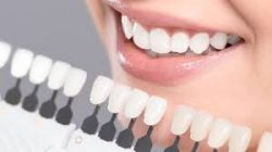 Have shiny teeth with laser teeth whitening