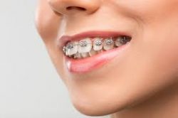 Are Expander Braces Good for Adults? | Palate Expander Cost, Types
