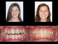Life With Braces Before And After Overbite