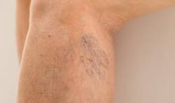 Red Thread Vein Removal Treatment